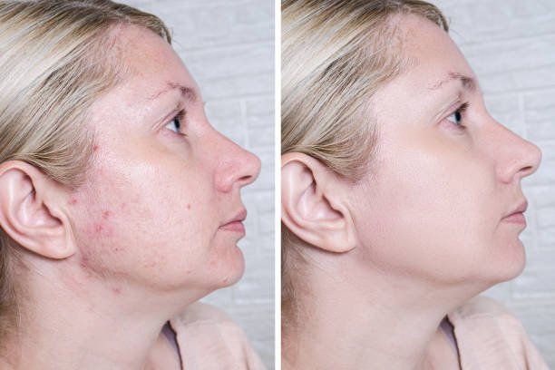 Before and After result B